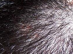 秃发性毛囊炎会引起患者脱发吗